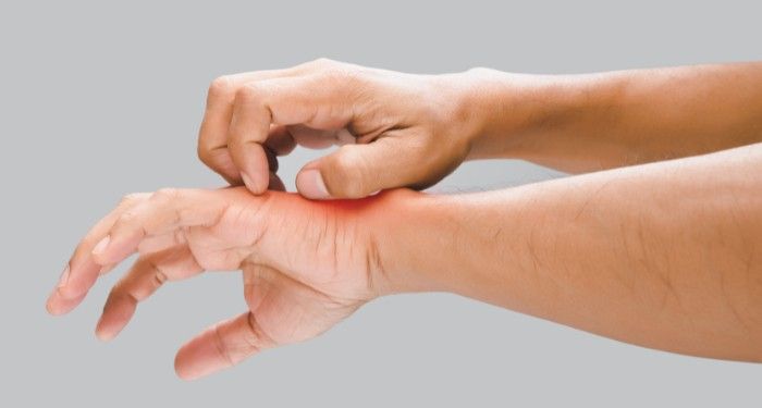 someone with pale skin scratching their hand